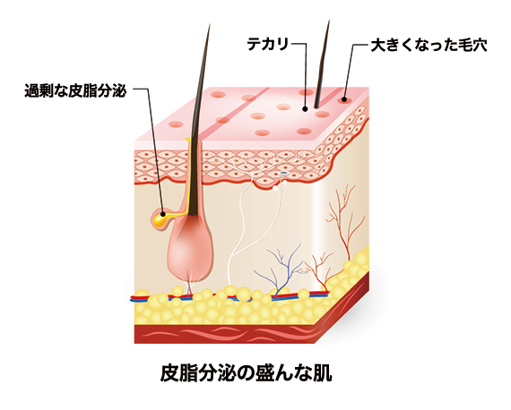 皮脂分泌の盛んな肌