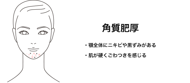 本当の原因はコレ！繰り返す大人の顎ニキビを治す方法