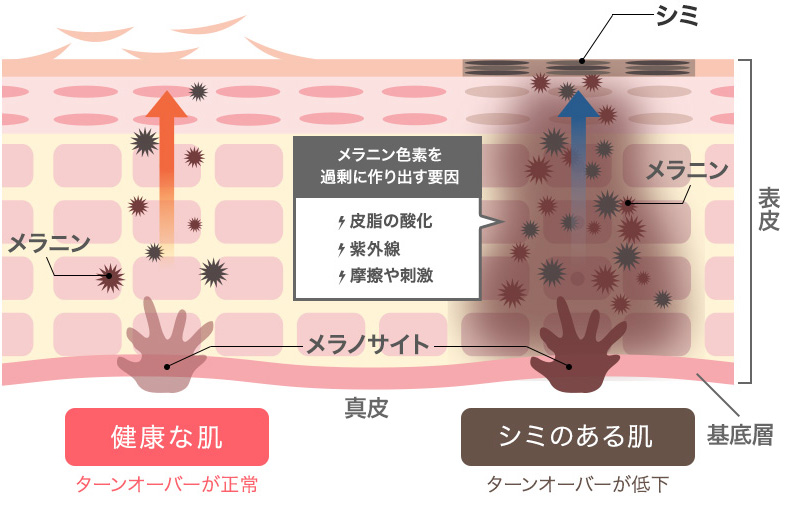 ホワイトケアの強い味方！ハイドロキノンの効果と作用とは？