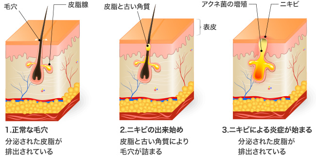 意外と厄介 眉に出来るニキビの原因と対処法を徹底解説 B Glenish ビーグレンイッシュ スキンケア化粧品 サイエンスコスメのビーグレン