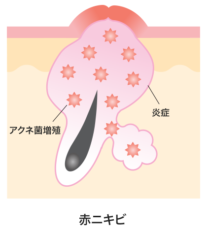 意外と厄介！眉に出来るニキビの原因と対処法を徹底解説