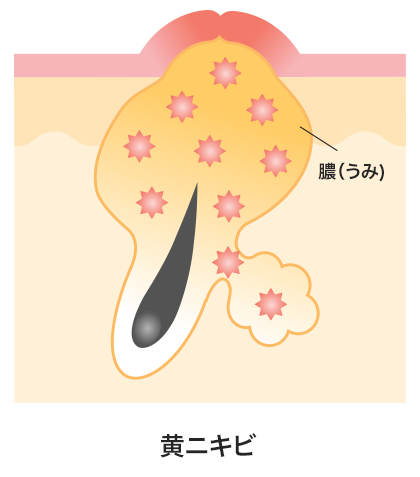 意外と厄介！眉に出来るニキビの原因と対処法を徹底解説