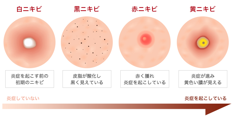 乾燥肌の正しいスキンケア方法で、この冬は「しっとり肌」を実現！