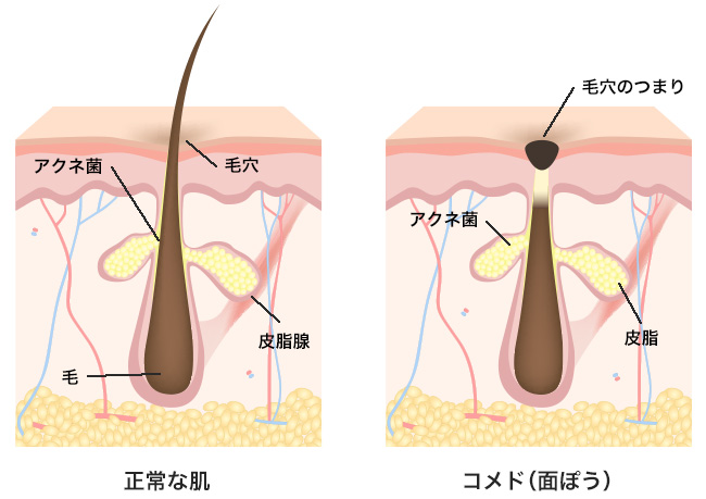 乾燥肌の正しいスキンケア方法で、この冬は「しっとり肌」を実現！