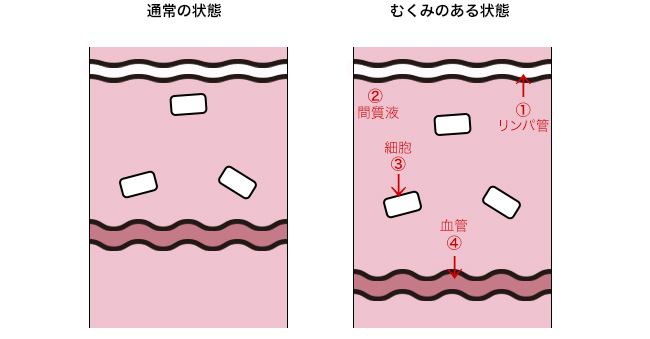 通常、体内の水分割合は、一定に保たれているが、細胞間隙の水分（間質液）が多くなることがある。これがむくみである。