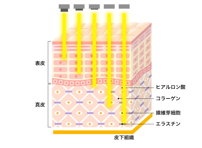 美容クリニックの施術や治療って？おすすめ施術【悩み別】徹底解説！①【シミ・美白】フォトフェイシャル