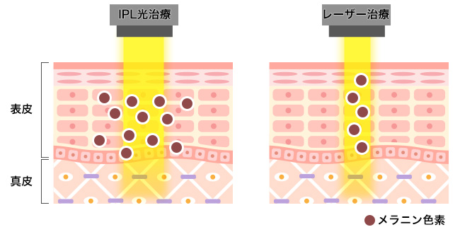 美容クリニックの施術や治療って？おすすめ施術【悩み別】徹底解説！①【シミ・美白】フォトフェイシャル