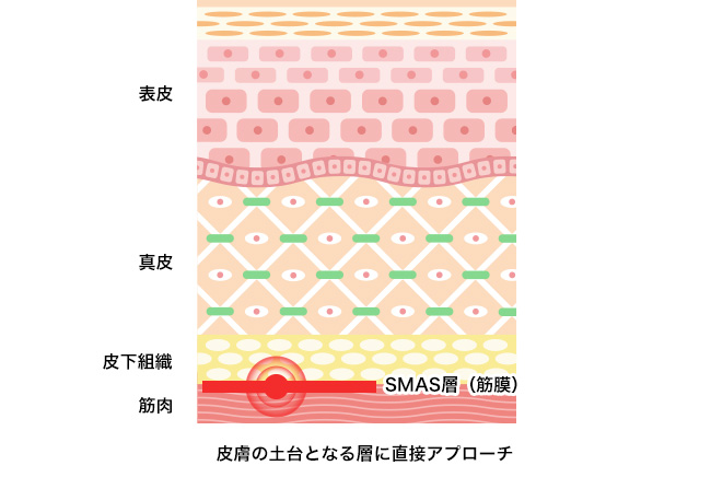 美容クリニックの施術や治療って？おすすめ施術【悩み別】徹底解説！②【しわ・たるみ・ほうれい線】ウルトラセルQプラス