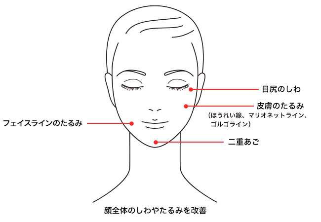 美容クリニックの施術や治療って？おすすめ施術【悩み別】徹底解説！②【しわ・たるみ・ほうれい線】ウルトラセルQプラス