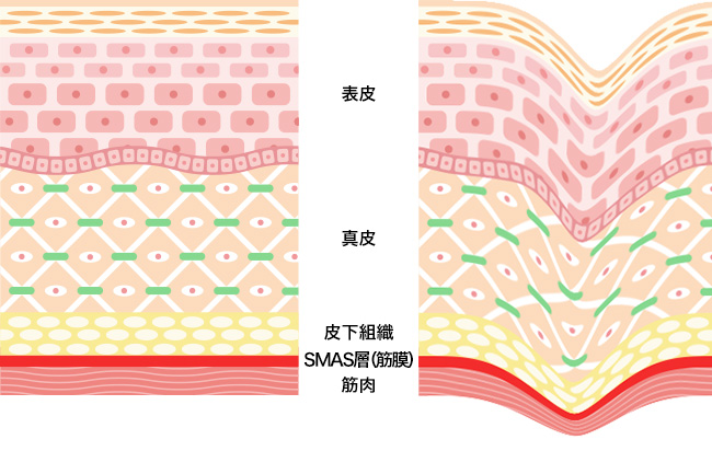 美容クリニックの施術や治療って？おすすめ施術【悩み別】徹底解説！②【しわ・たるみ・ほうれい線】ウルトラセルQプラス