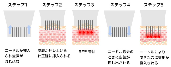 美容クリニックの施術や治療って？おすすめ施術【悩み別】徹底解説！③【ニキビ・毛穴】ポテンツァ（POTENZA）