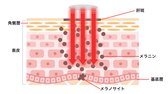 美容クリニックの施術や治療って？おすすめ施術【悩み別】徹底解説！③【ニキビ・毛穴】ポテンツァ（POTENZA）