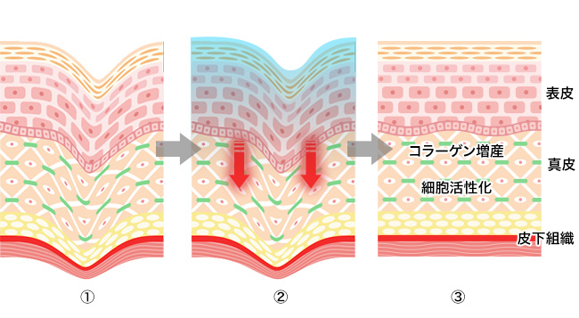 美容クリニックの施術や治療って？おすすめ施術【悩み別】徹底解説！⑤【シミ・美白】コラーゲンピール（マッサージピール）