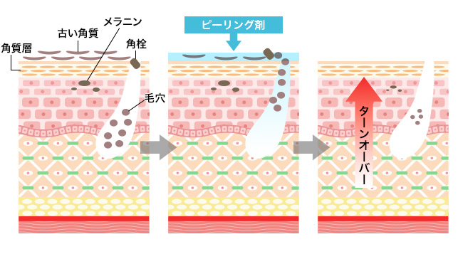 サリチル酸マクロゴールピーリングのメカニズム