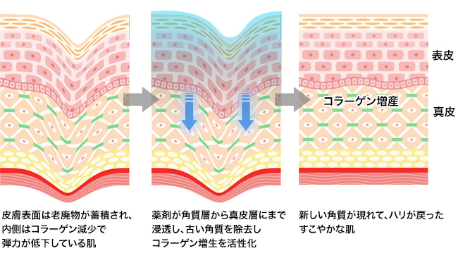 美容クリニックの施術や治療って？おすすめ施術【悩み別】徹底解説！⑦【ニキビ・毛穴】ミラノリピール